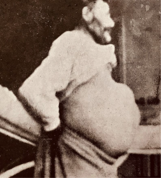 Fig. S1 (from the supplement of the original article).
A man in Iceland with cystic echinococcosis; late 19th century (photo obtained from Matthías Einarsson/Eiríkur Jónsson)
